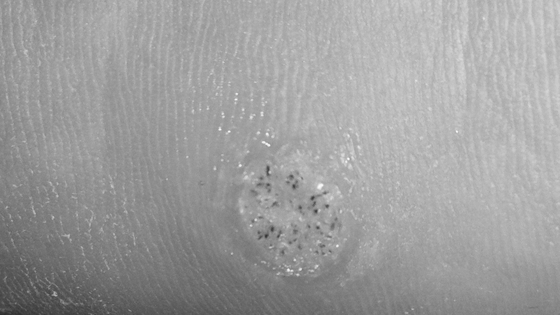 Aromatherapy A-Z: Warts and Verrucas
