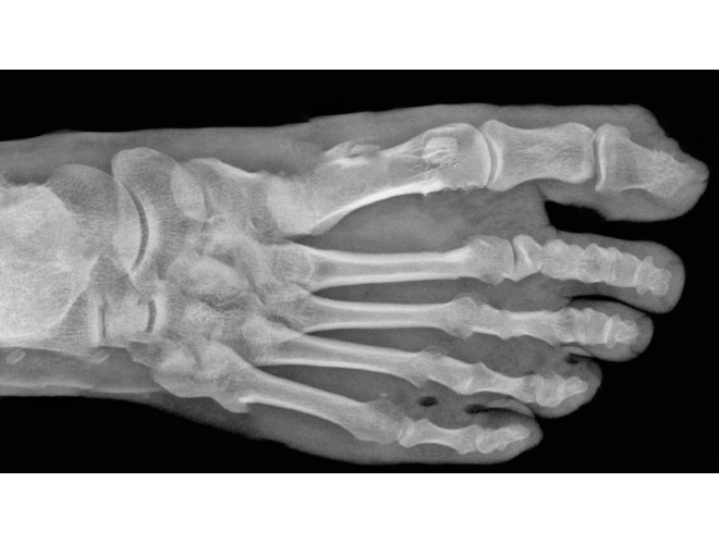Q&A: Aromatherapy advice for broken bones?