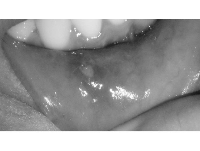 Aromatherapy essential oils for mouth ulcers
