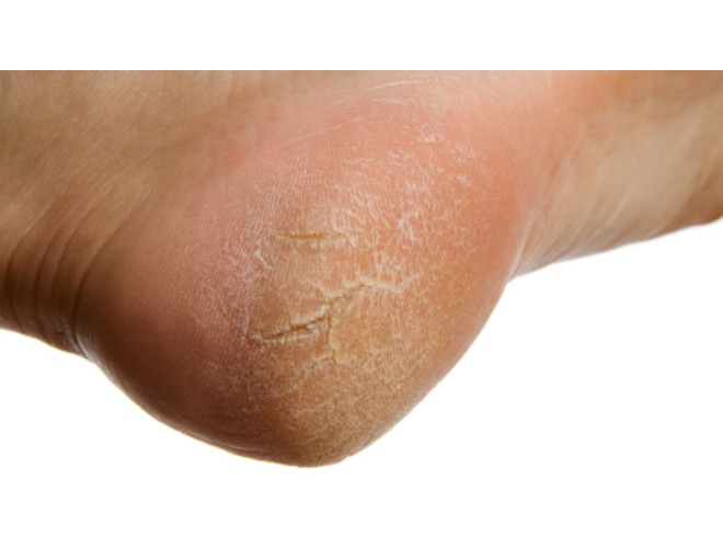 Aromatherapy essential oils for cracked skin Aromatherapy essential oils for cracked skin