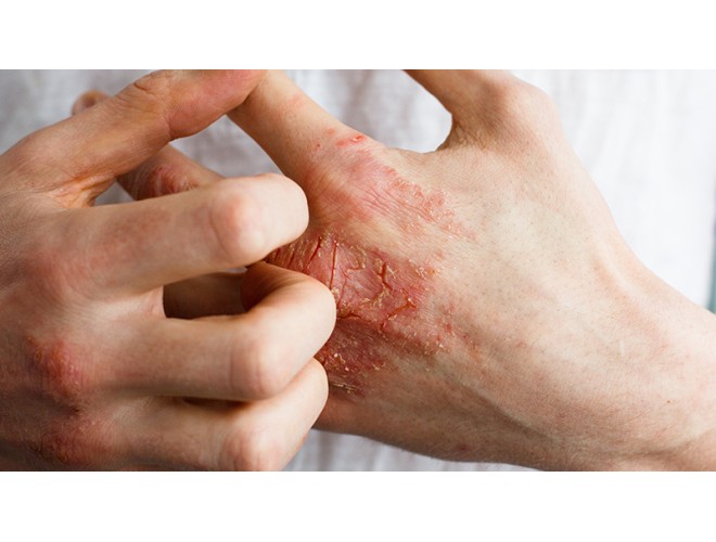Holistic advice for inflamed skin conditions Holistic advice for inflamed skin conditions
