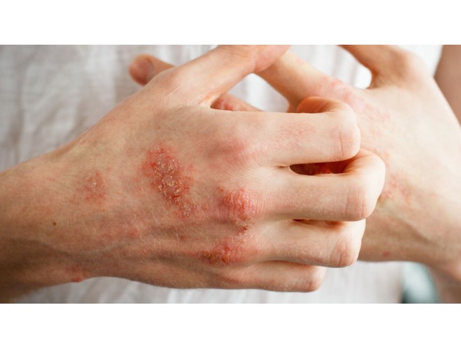 Aromatherapy essential oils for psoriasis